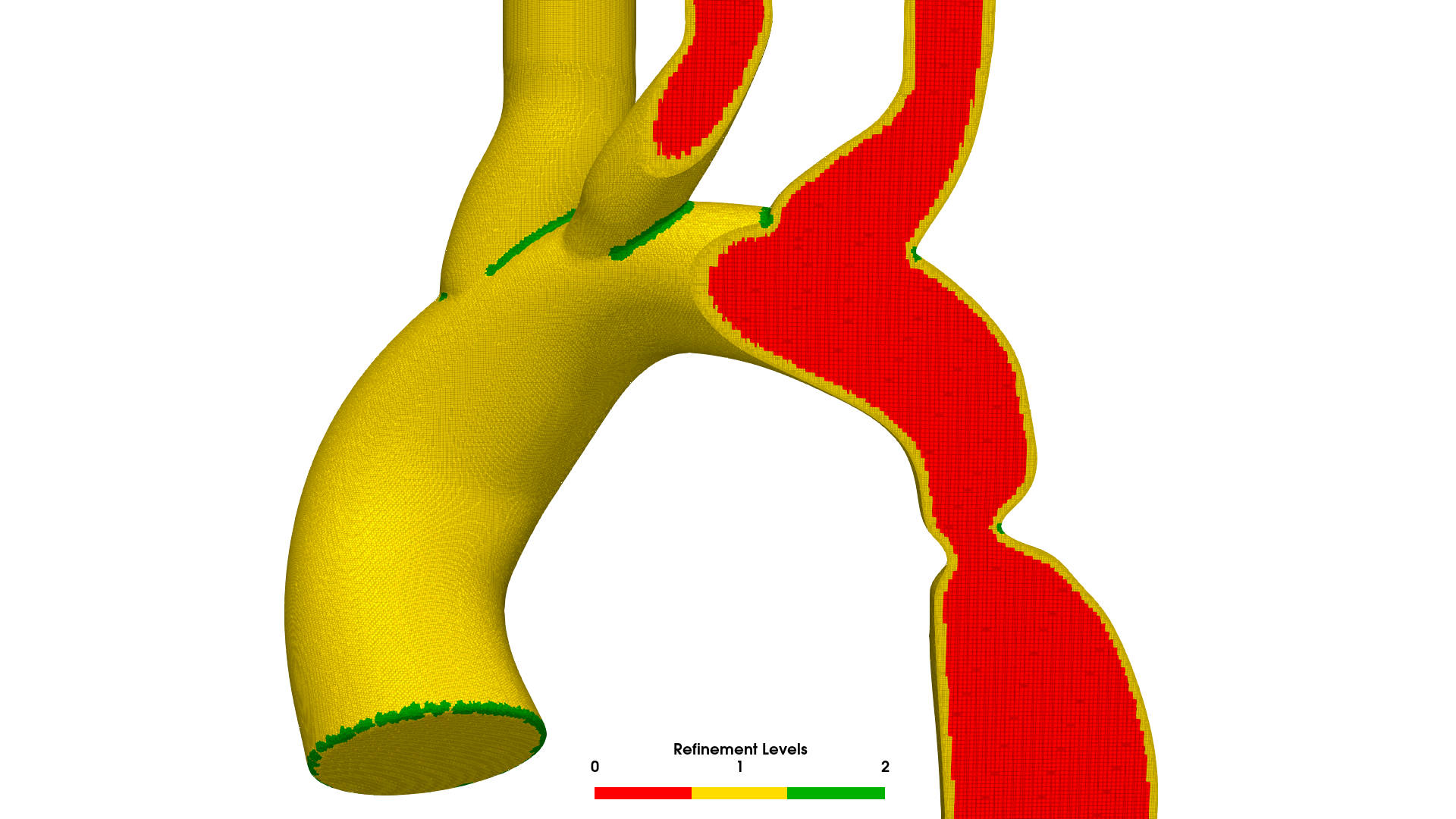 BPM120 patient aorta mesh